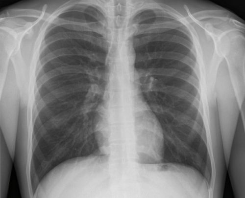 Lung Xray